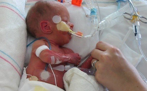 Hội chứng suy hô hấp cấp ở trẻ sơ sinh và những điều cần biết