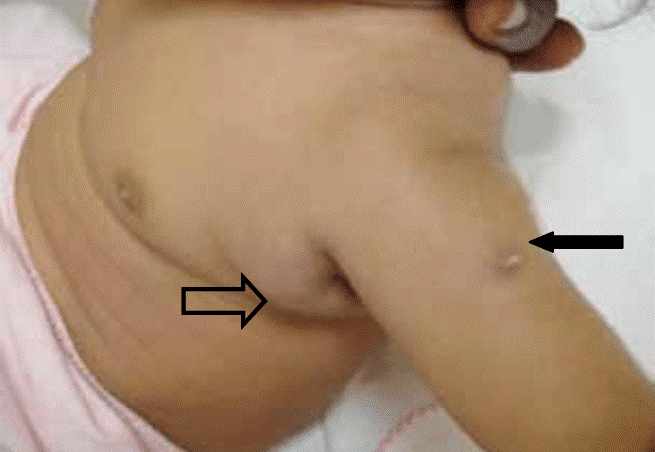 Viêm hạch bạch huyết ở trẻ em  do vắc-xin BCG