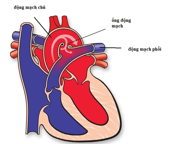 Bệnh tim bẩm sinh: Còn ống động mạch – Tồn tại lỗ bầu dục