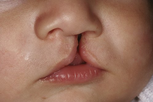 Dị tật khe hở môi vòm (hở hàm ếch): Trẻ vẫn có cơ hội phát triển bình thường