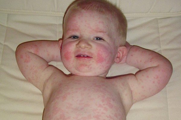 Bệnh thứ năm: Ban đỏ nhiễm khuẩn, bệnh lý thường gặp ở trẻ em