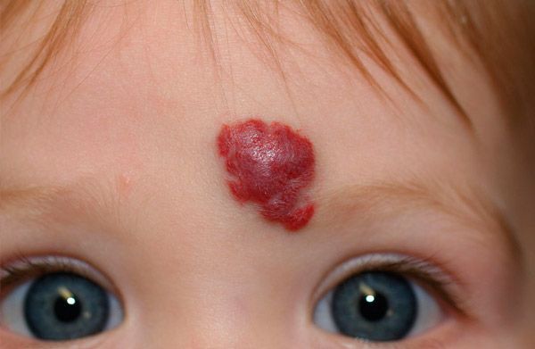 U máu ở trẻ: Những điều phụ huynh cần biết