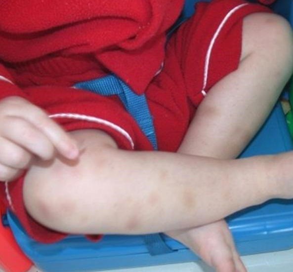 Giảm tiểu cầu ở trẻ em: Nguyên nhân, triệu chứng và điều trị