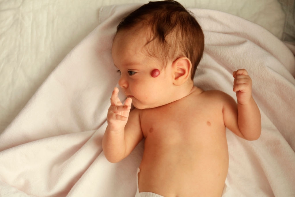 Bướu máu ở trẻ sơ sinh: Những điều cần biết