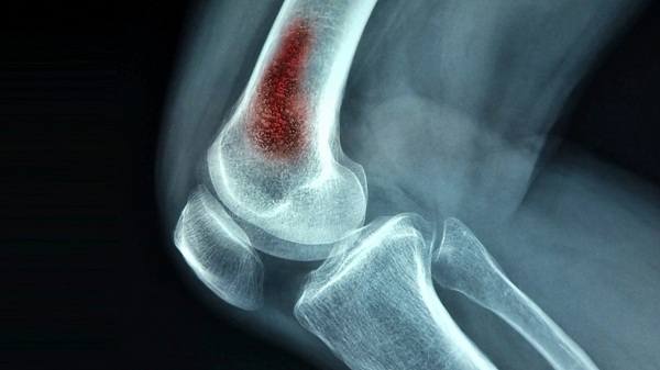 Bệnh viêm tủy xương: Cách chẩn đoán và điều trị