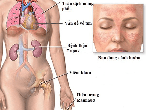 Bệnh thận lupus: biểu hiện, chẩn đoán và điều trị