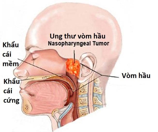Ung thư vòm họng giai đoạn 2: dấu hiệu, tỷ lệ chữa khỏi, cách điều trị