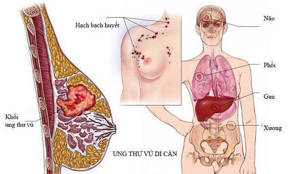 Các giai đoạn của ung thư vú có thể bạn chưa biết
