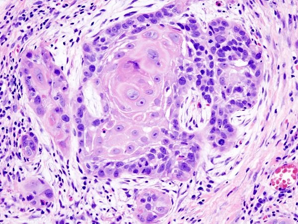 Ung thư tế bào vảy: Triệu chứng và cách điều trị
