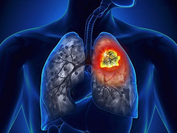 Những nguyên nhân ung thư phổi mà bạn cần chú ý