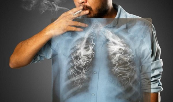 Ung thư phổi sống được bao lâu và câu trả lời của bác sĩ