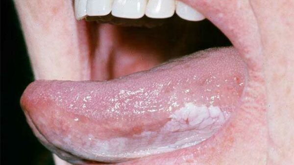 Những dấu hiệu ung thư lưỡi mà bạn nên biết