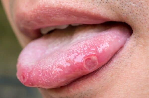 Cách nhận biết Ung thư lưỡi: Những cảnh báo từ chuyên gia