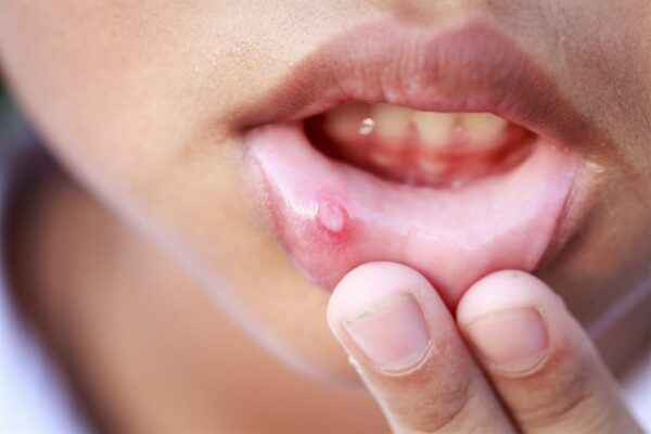 Cách nhận biết Ung thư lưỡi: Những cảnh báo từ chuyên gia