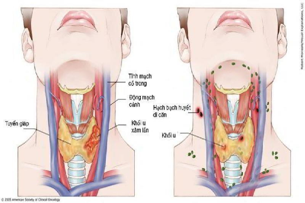 Dấu hiệu ung thư vòm họng mà bạn nên biết