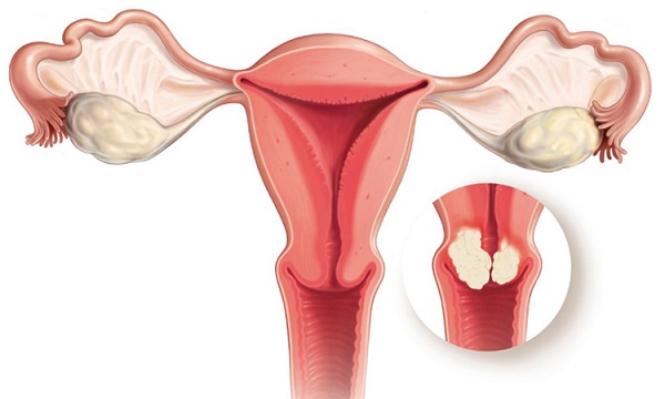 Những phương pháp điều trị ung thư cổ tử cung chị em phụ nữ nên biết