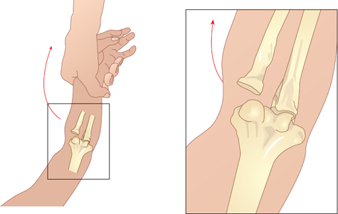 Trật khuỷu tay: Nguyên nhân, chẩn đoán và điều trị