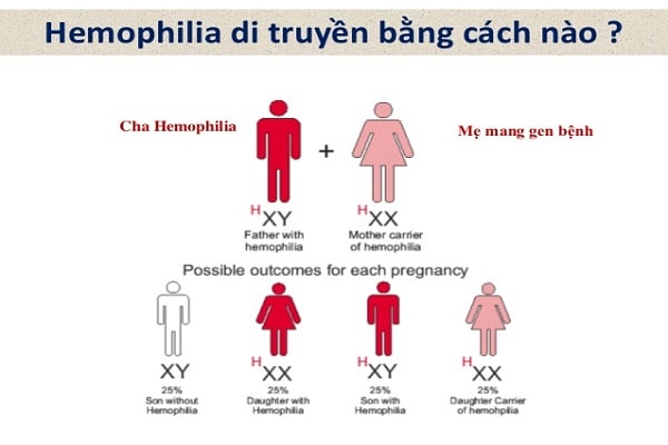 Hemophilia A: Nguyên nhân, triệu chứng và cách điều trị bệnh