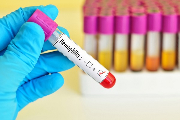 Hemophilia A: Nguyên nhân, triệu chứng và cách điều trị bệnh