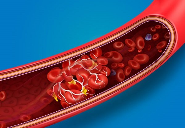 Bệnh đa hồng cầu nguyên phát: Biểu hiện, chẩn đoán và điều trị