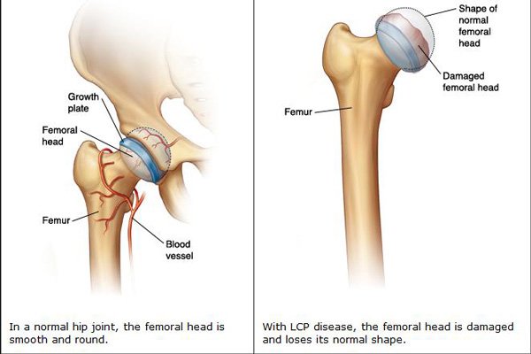 Viêm xương sụn khớp háng nguyên phát: Nguyên nhân, chẩn đoán và điều trị