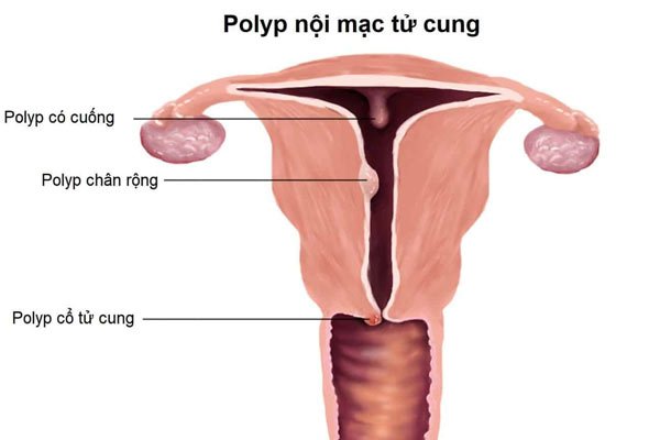 Polyp tử cung: Những điều cần biết!