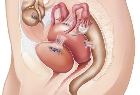 Lạc nội mạc tử cung có nguy hiểm không?