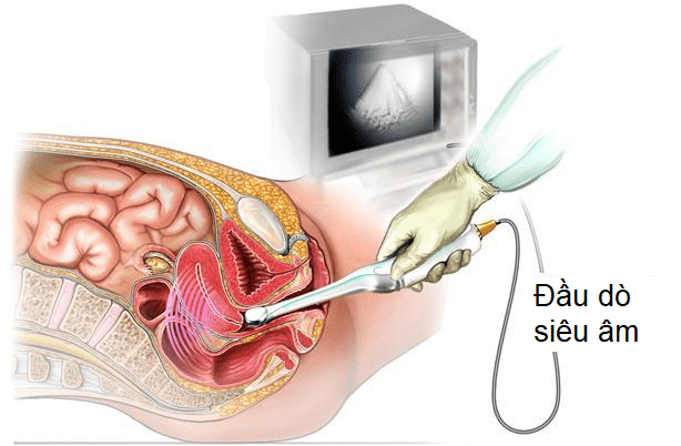 Lạc nội mạc tử cung: Chẩn đoán và điều trị