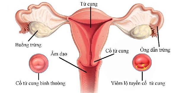 Viêm cổ tử cung là gì? Có ảnh hưởng đến mang thai không?