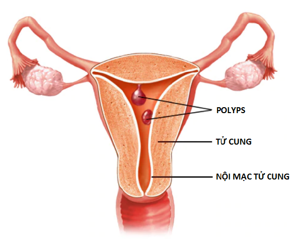Polyp tử cung và thai kỳ: Những điều cần biết