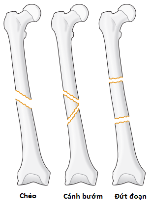 Kiến thức về gãy xương chân