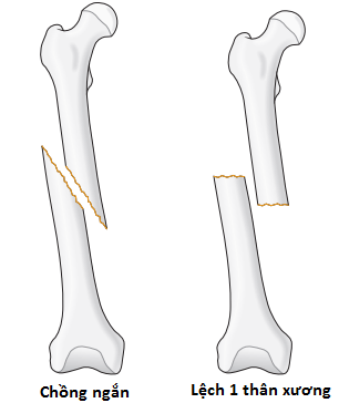 Kiến thức về gãy xương chân