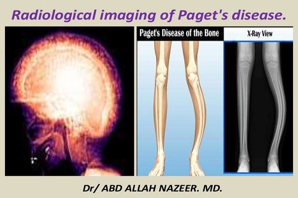 Bệnh xương của Paget: Nguyên nhân, triệu chứng và cách điều trị bệnh