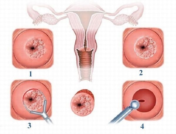 Viêm tái tạo cổ tử cung: bệnh lý nguy hiểm cần lưu ý