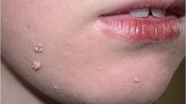 Nhiễm virus HPV trong một số bệnh ở miệng