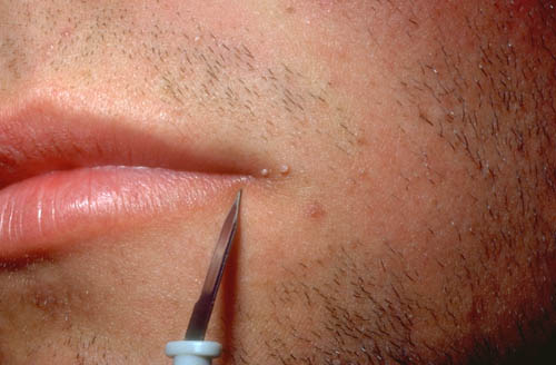 Nhiễm virus HPV trong một số bệnh ở miệng