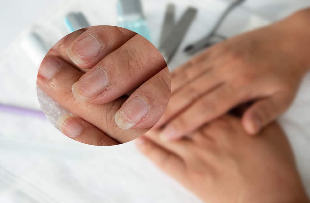 Móng tay bị rỗ là bệnh gì? Điều trị như thế nào hiệu quả?