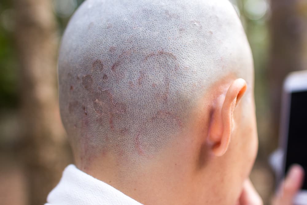 Các bệnh về da đầu ở nam giới: Nhận diện sớm, ngăn chặn nhanh!