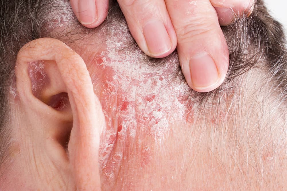 Các bệnh về da đầu ở nam giới: Nhận diện sớm, ngăn chặn nhanh!