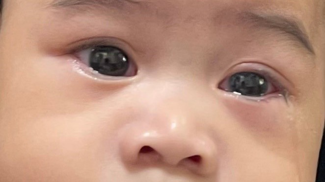 Đỏ mắt, chảy nước mắt cũng là một dấu hiệu của bệnh viêm giác mạc chấm nông